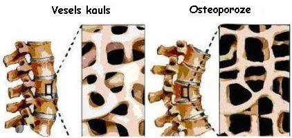 Gulbenē ir jauns veselības izmeklējums - osteodensitometrija