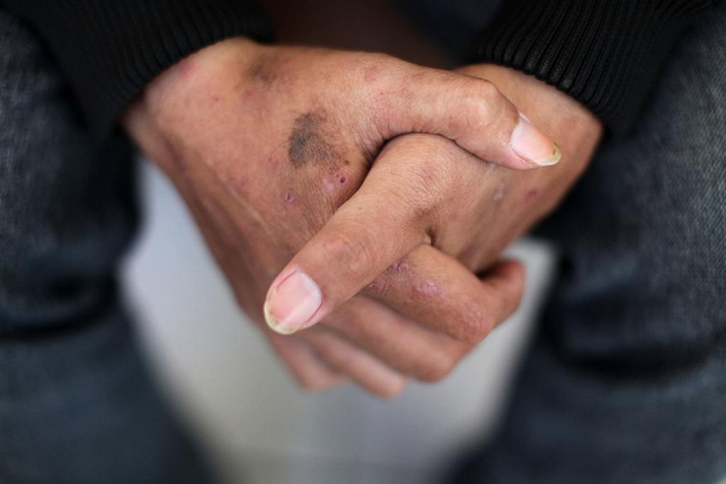 Ukrainai sāk trūkt medikamentu HIV ārstēšanai